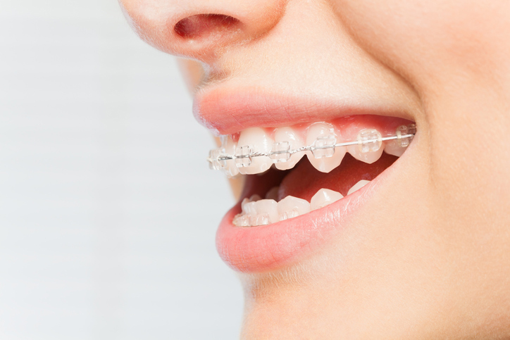 Die Schienen, die individuell angepasst werden, schieben bzw. ziehen die Zähne in die gewünschte Position.